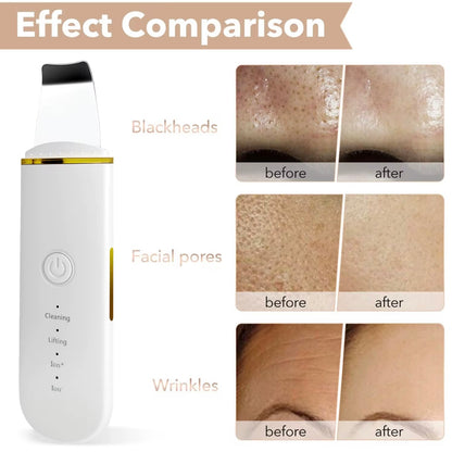 Electric Blackhead Pore Remover