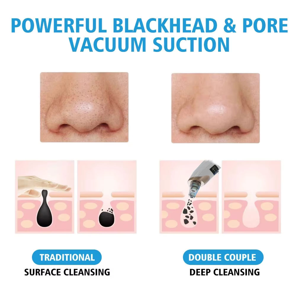 Blackhead Remover Pore Vacuum
